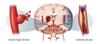 Illustration for article titled Obat Stroke Herbal Tradisional